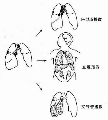 结核菌的传播途径